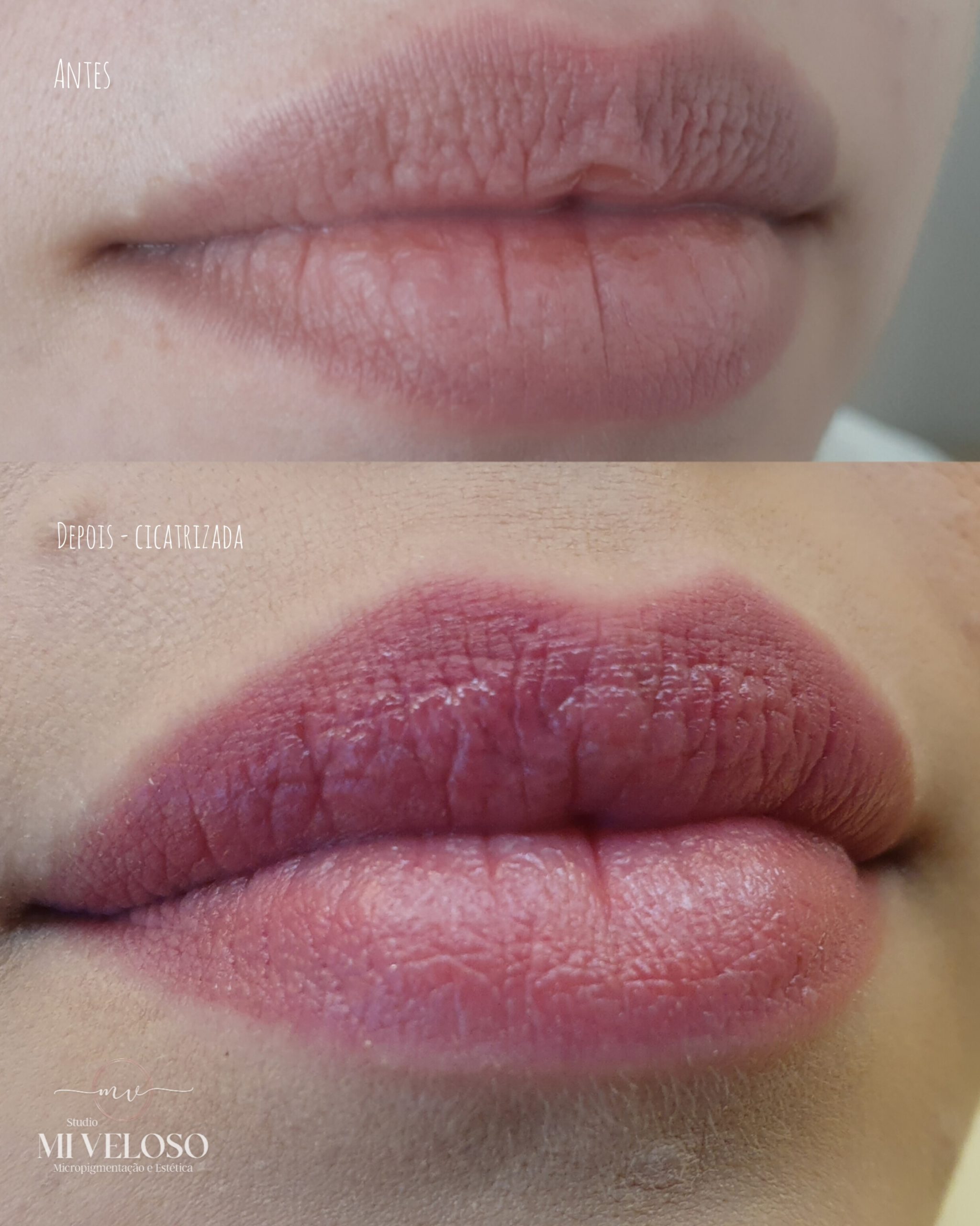 Micro Labial em Sobradinho DF 11