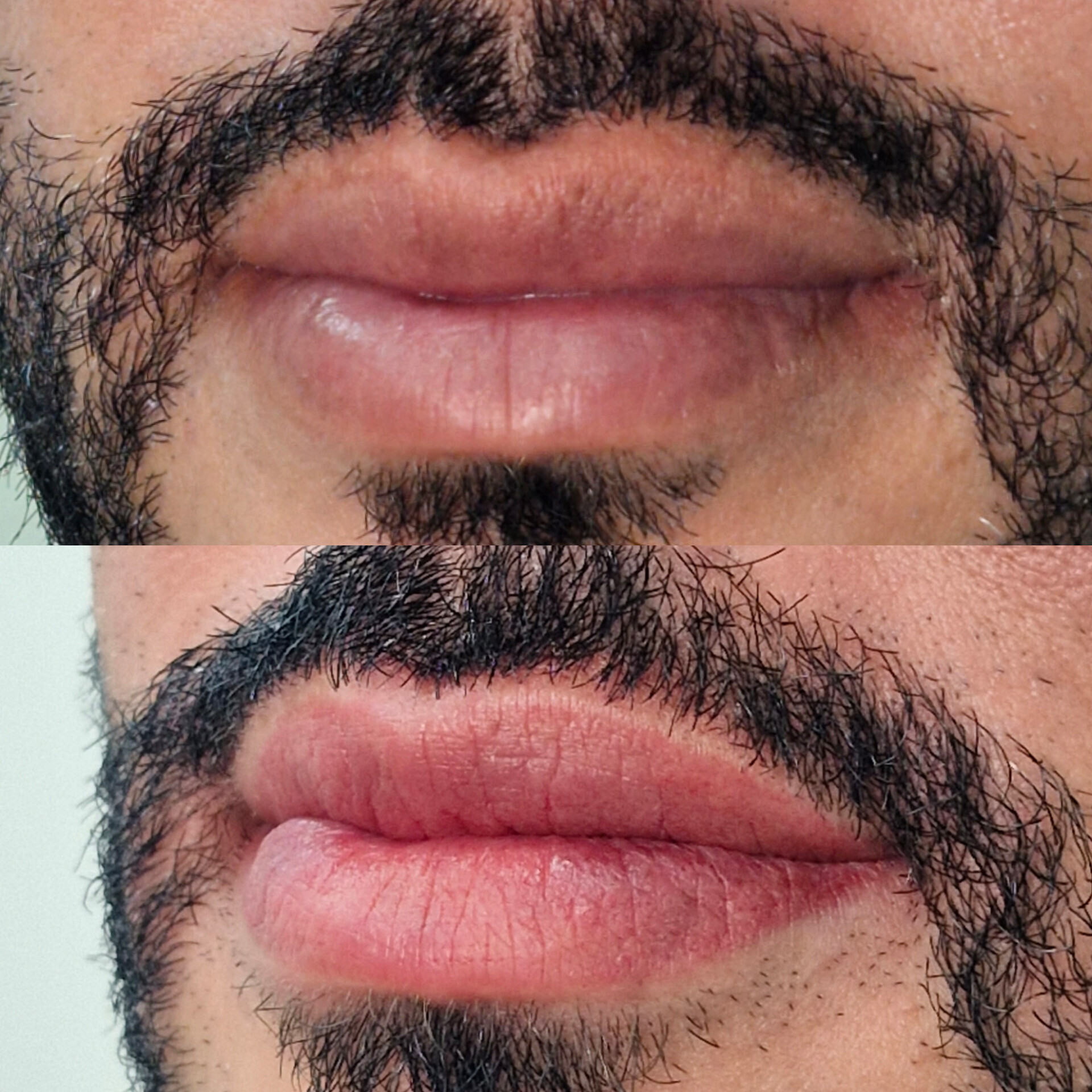 Micro Labial em Sobradinho DF 14