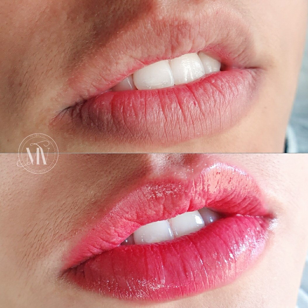 Micro Labial em Sobradinho DF 16