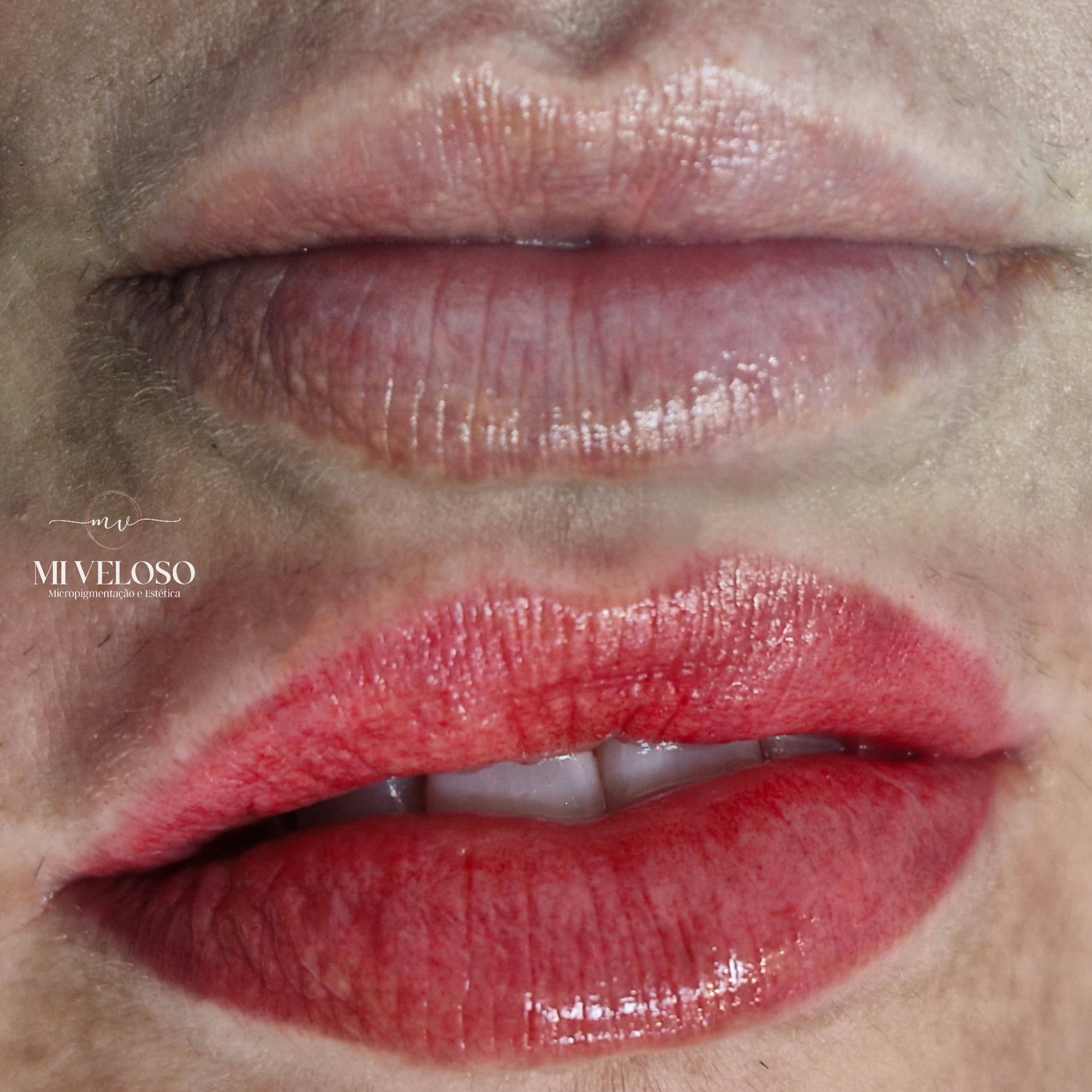 Micro Labial em Sobradinho DF 20