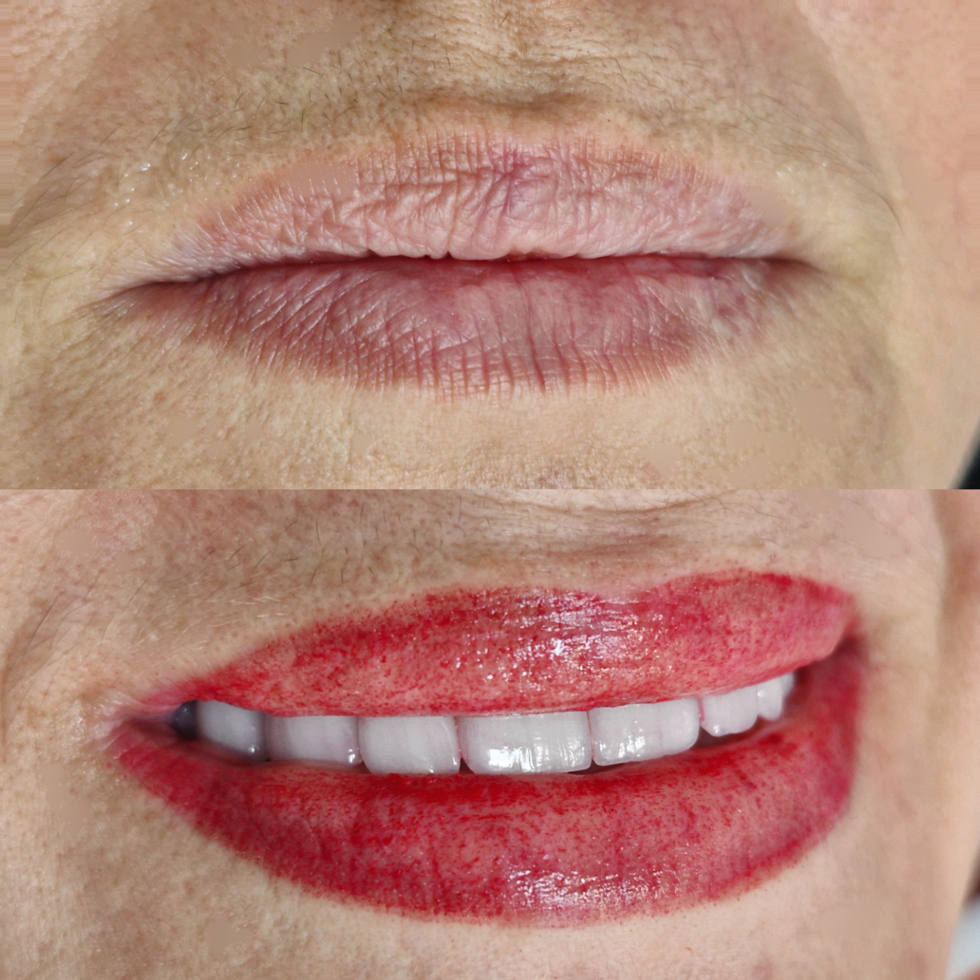 Micro Labial em Sobradinho DF 8