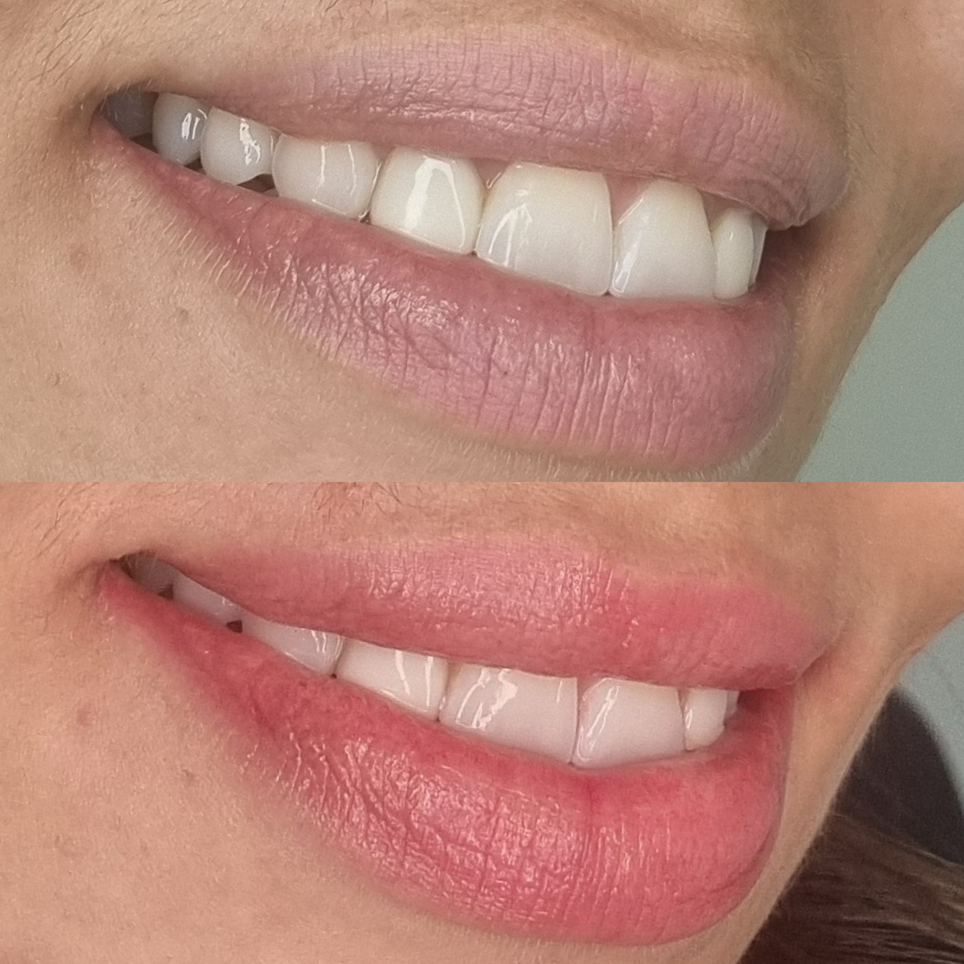 Micro Labial em Sobradinho DF 9