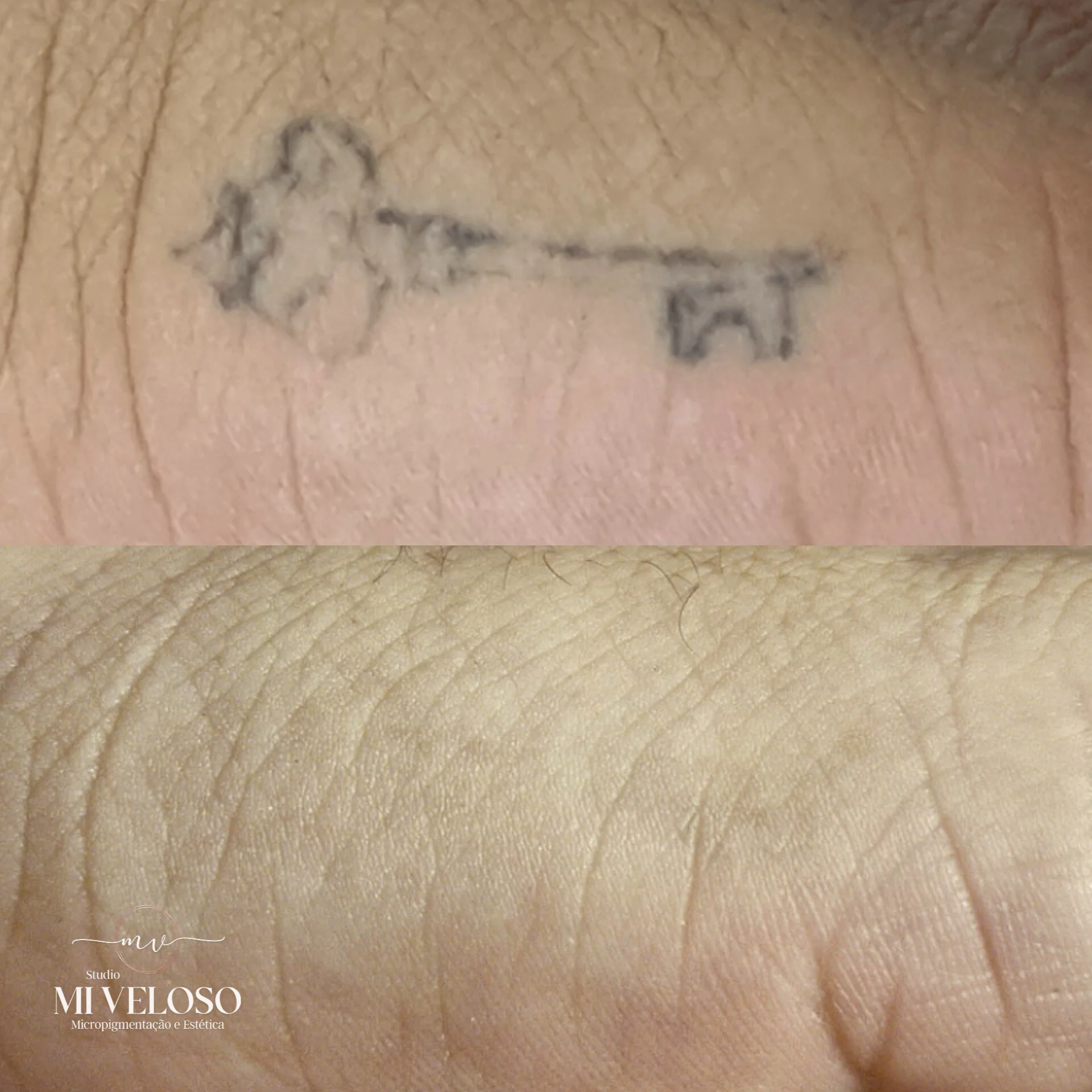 Despigmentação Tatuagem DF-02