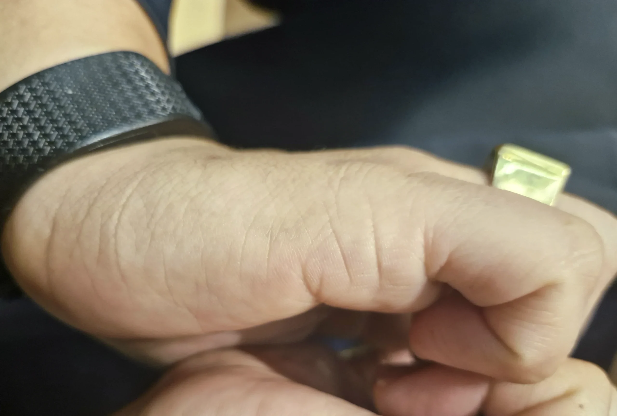 Despigmentação Tatuagem DF-03