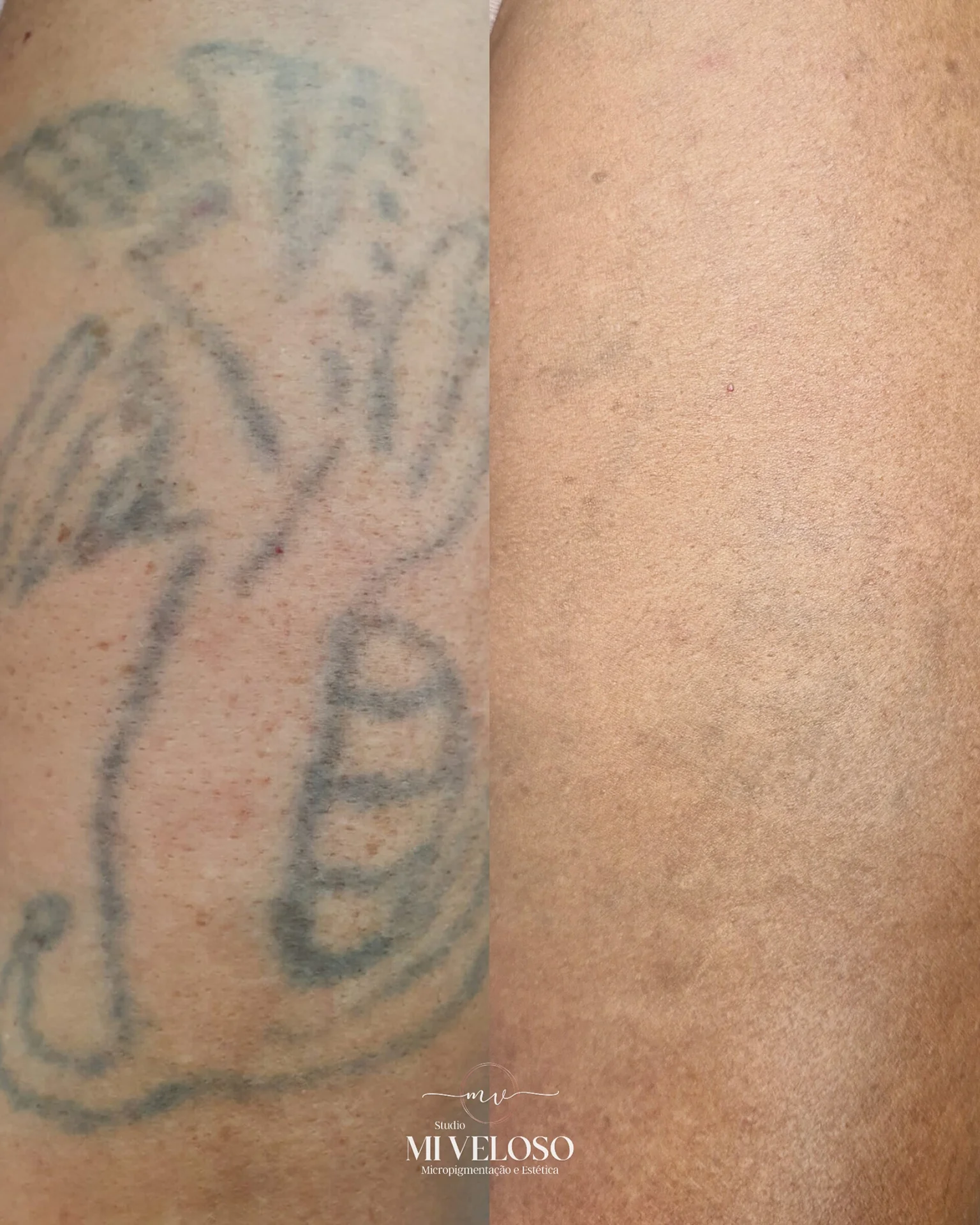 Despigmentação Tatuagem DF-04