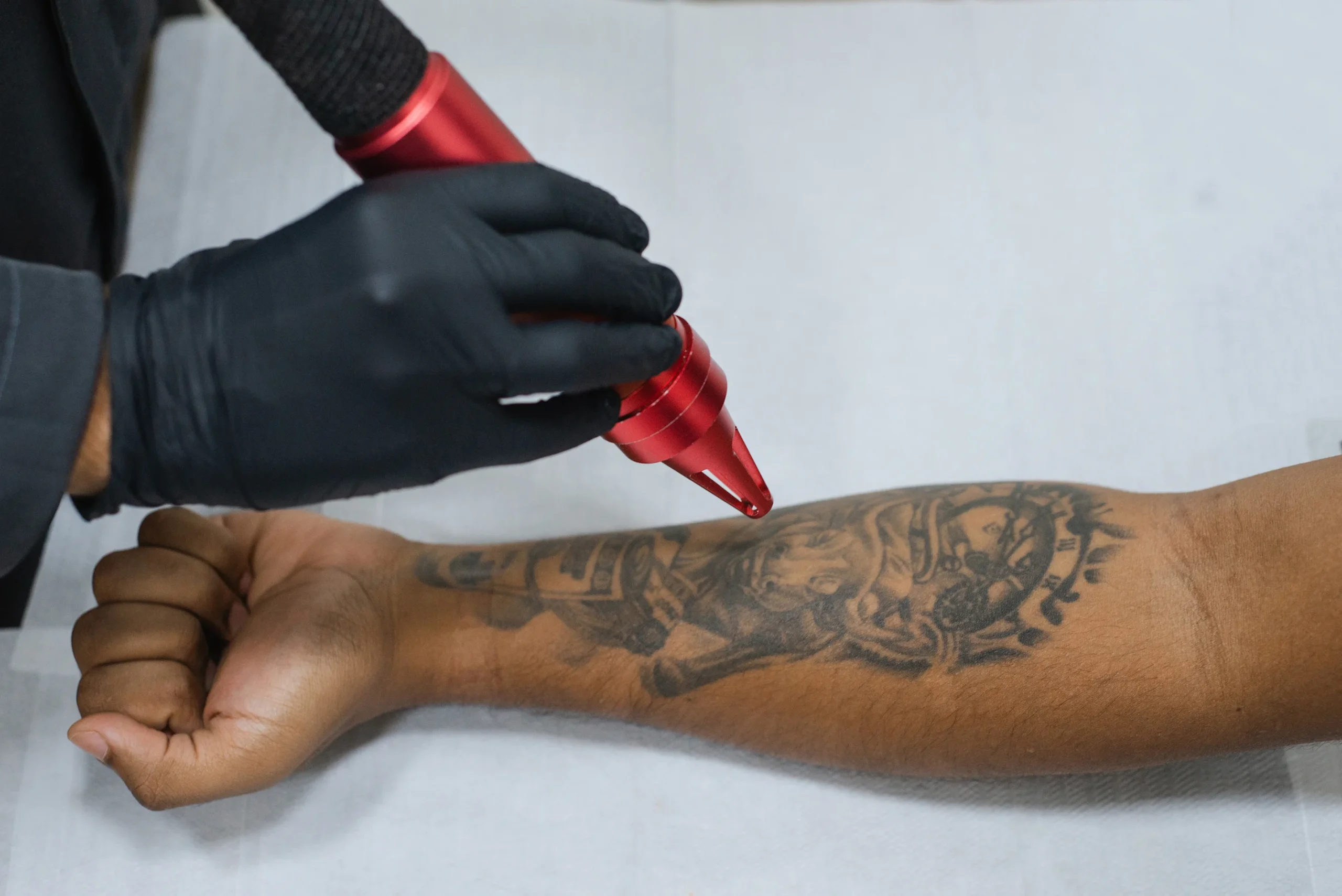 Despigmentação Tatuagem DF-05