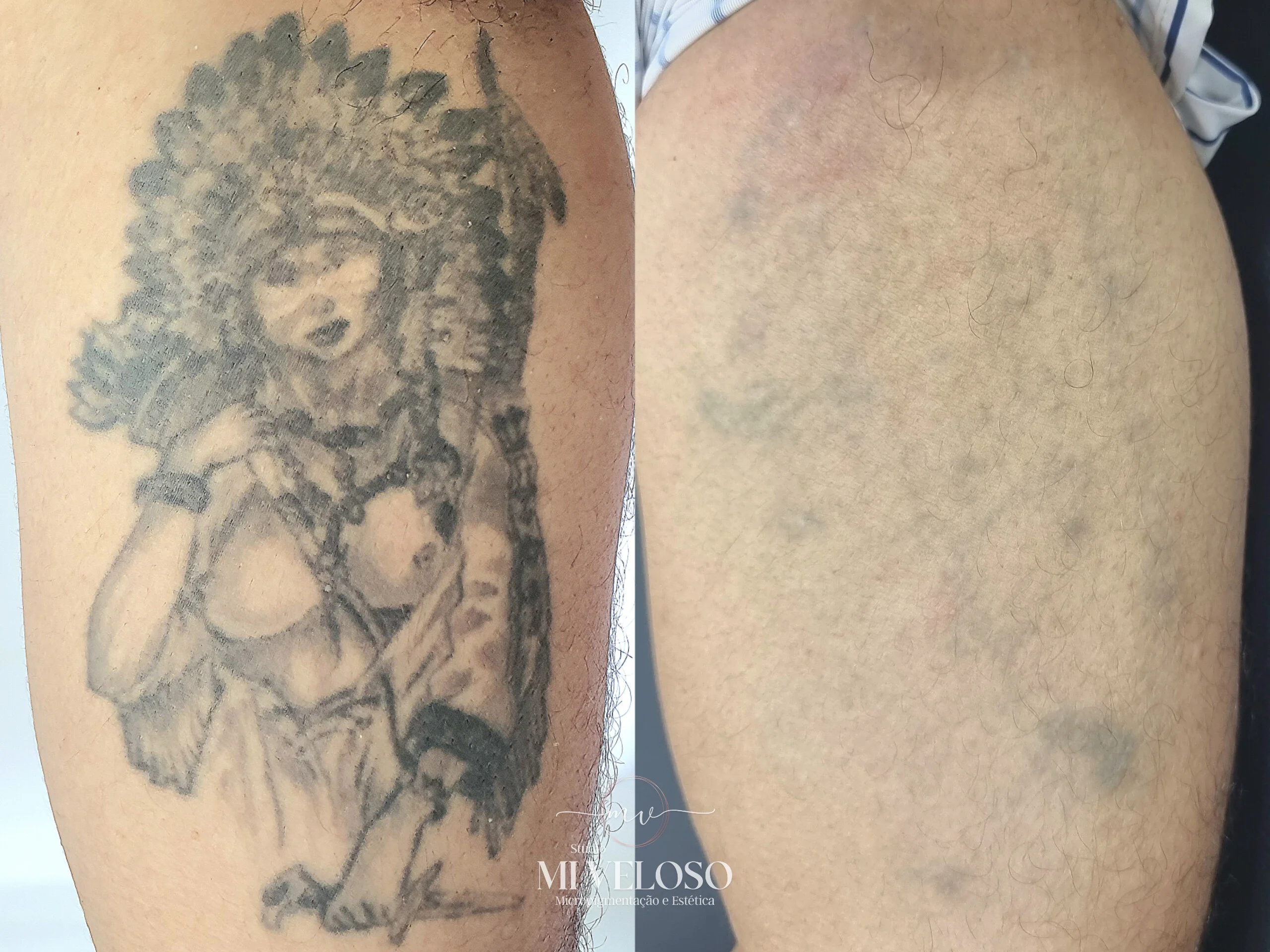 Despigmentação Tatuagem DF-06