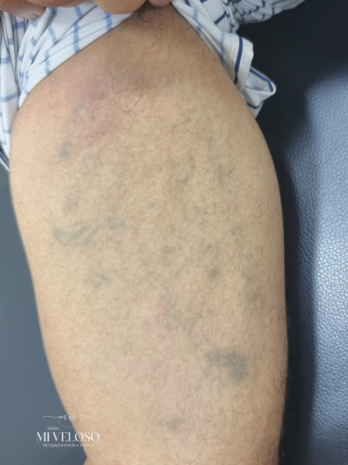 Despigmentação Tatuagem DF-07