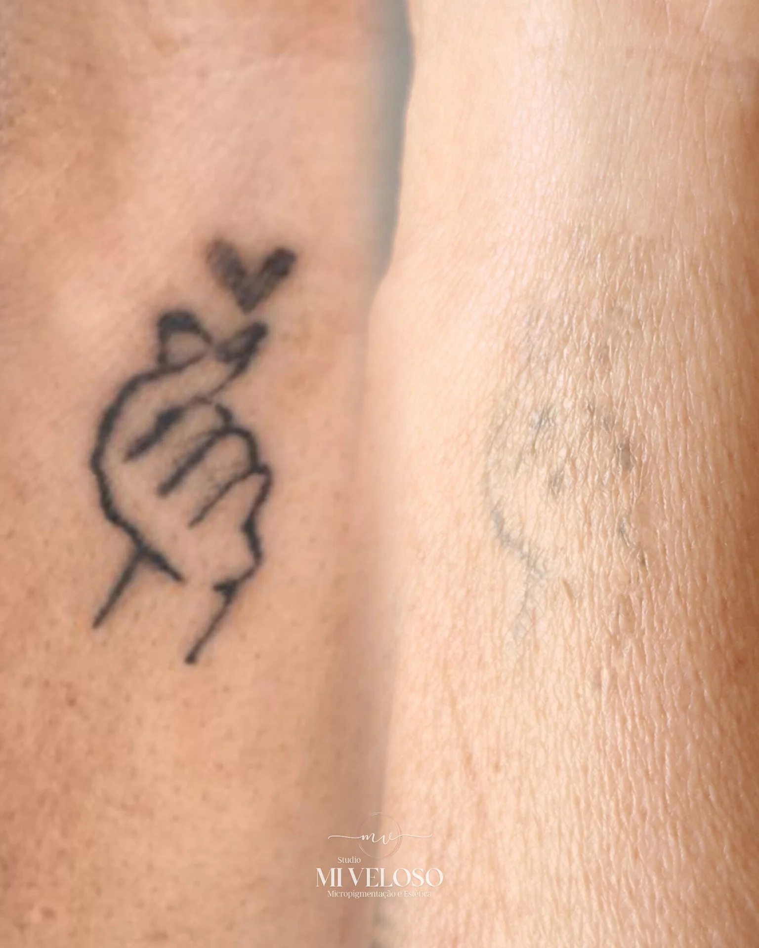 Despigmentação Tatuagem DF-09