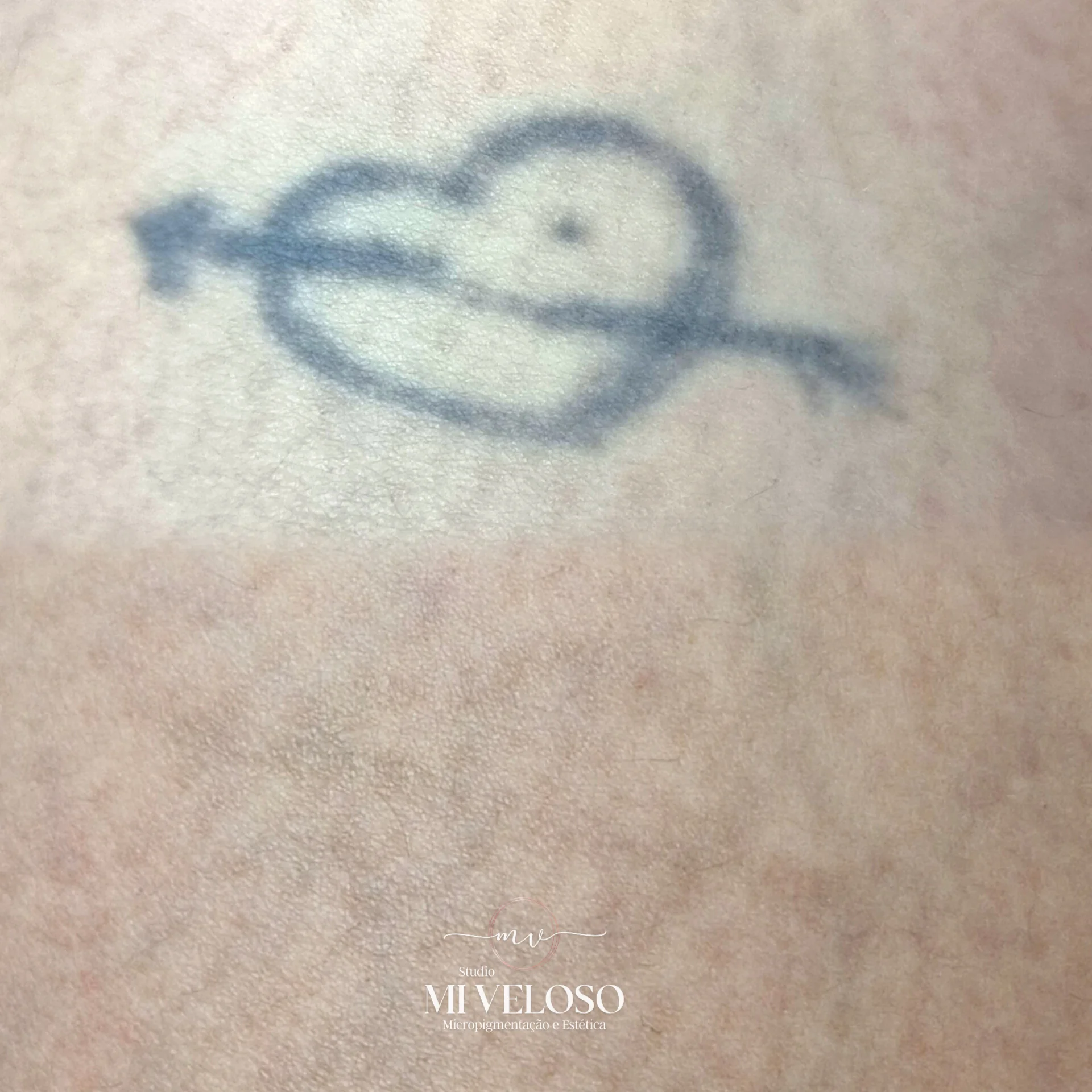 Despigmentação Tatuagem DF-11