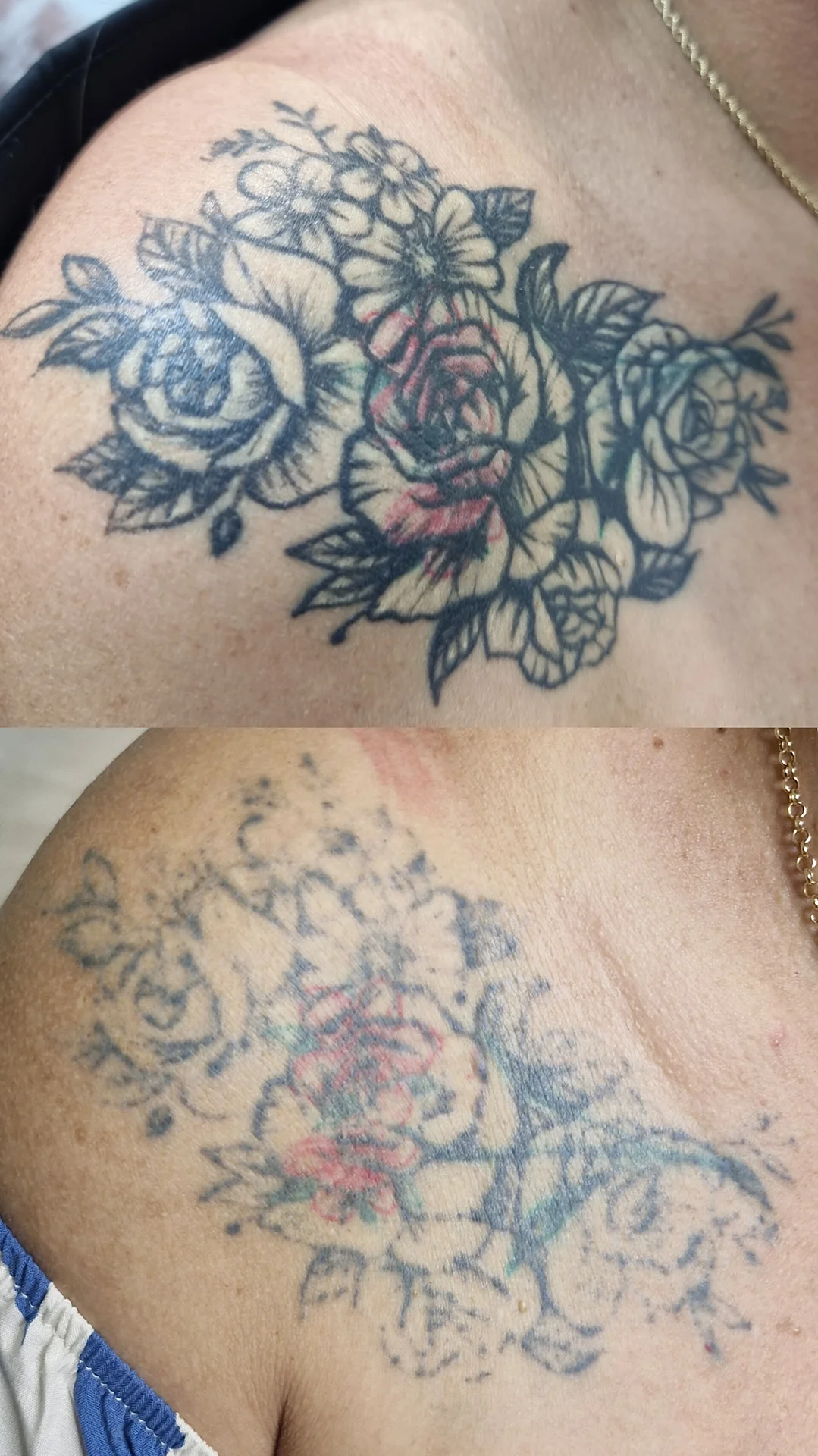 Despigmentação Tatuagem DF-14