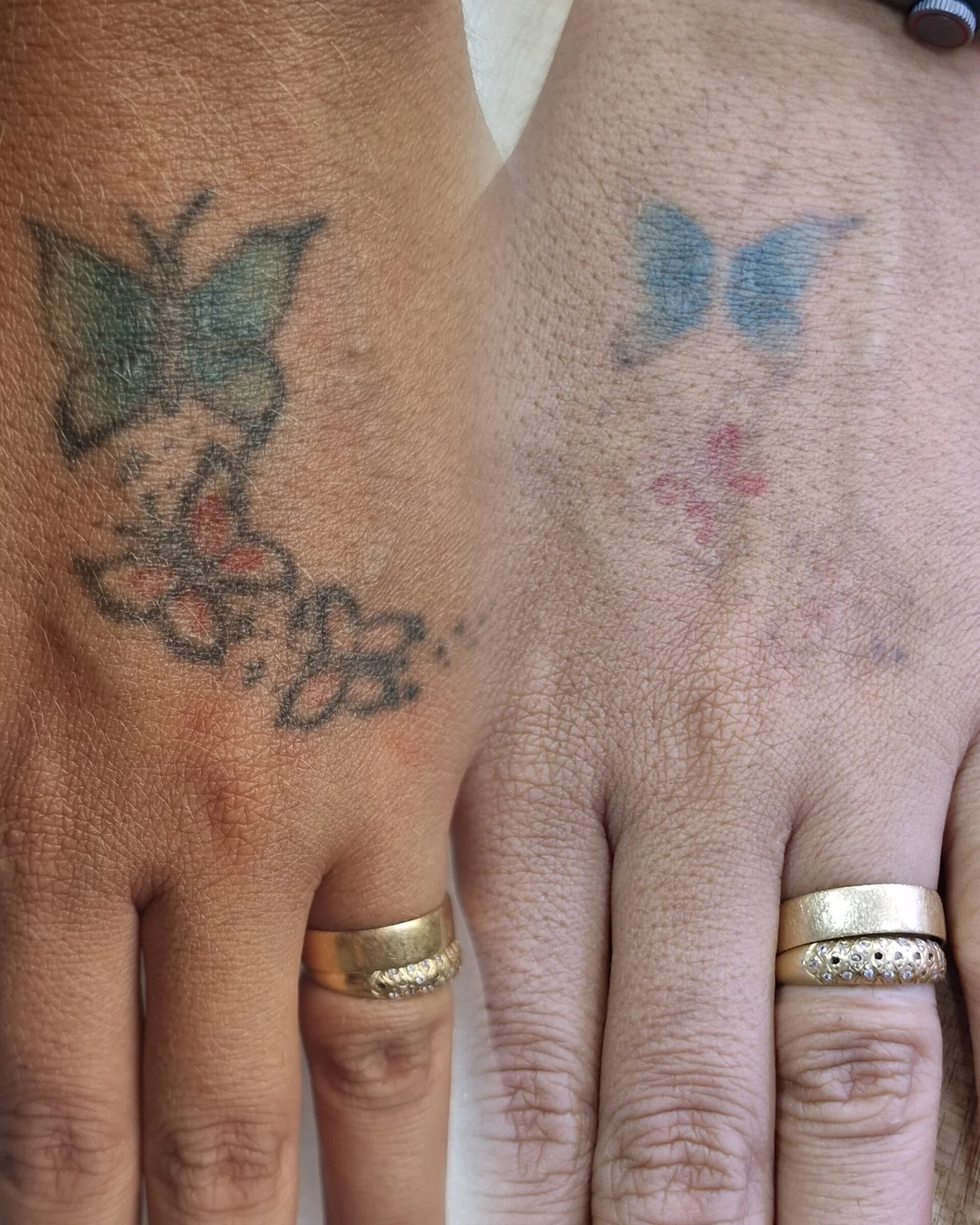 Despigmentação Tatuagem DF-16