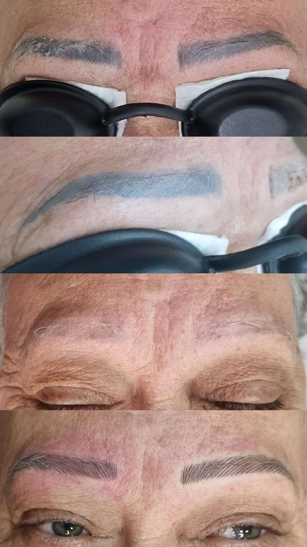 Despigmentação de Sobrancelhas DF-09