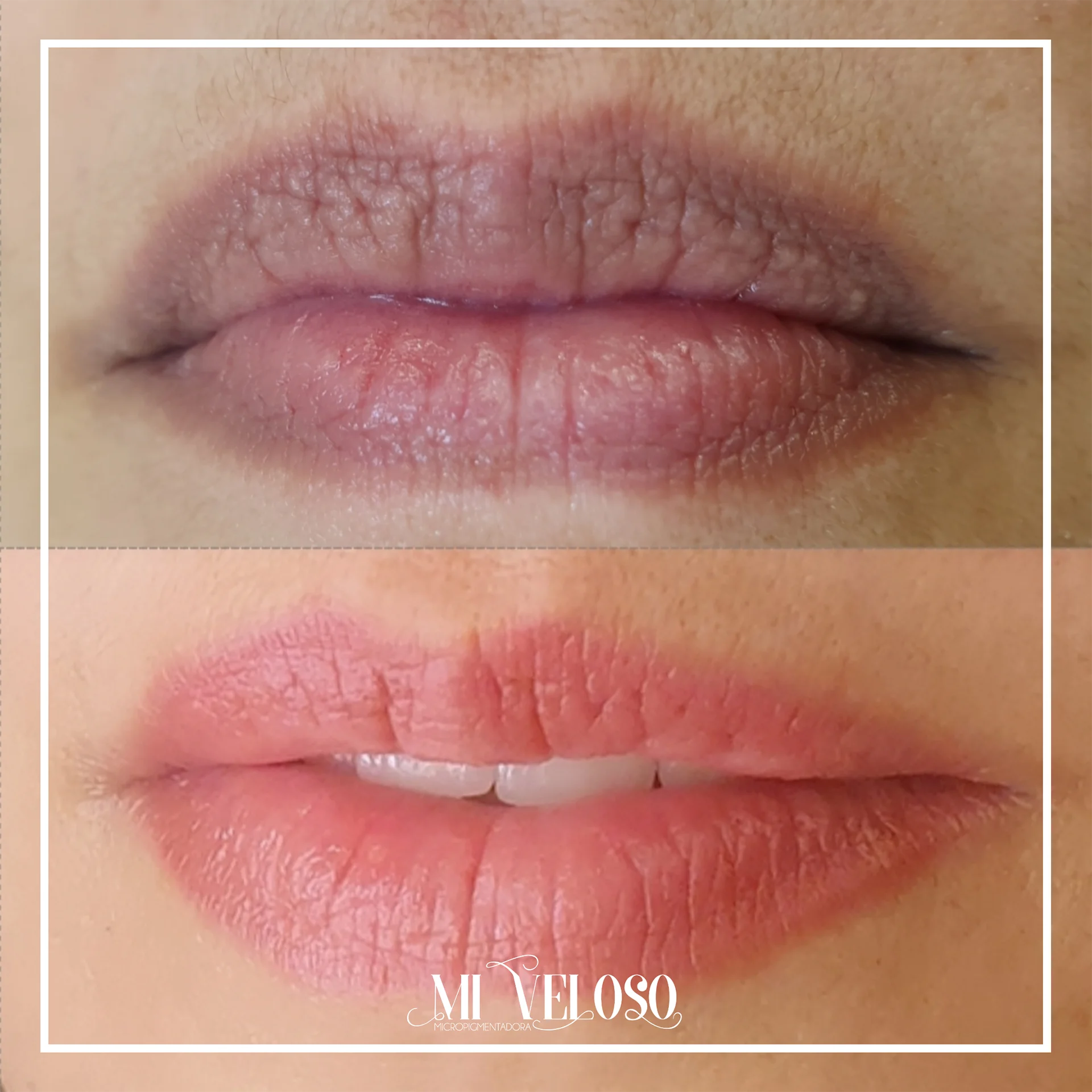 Micro-Labial-em-Sobradinho-DF-01