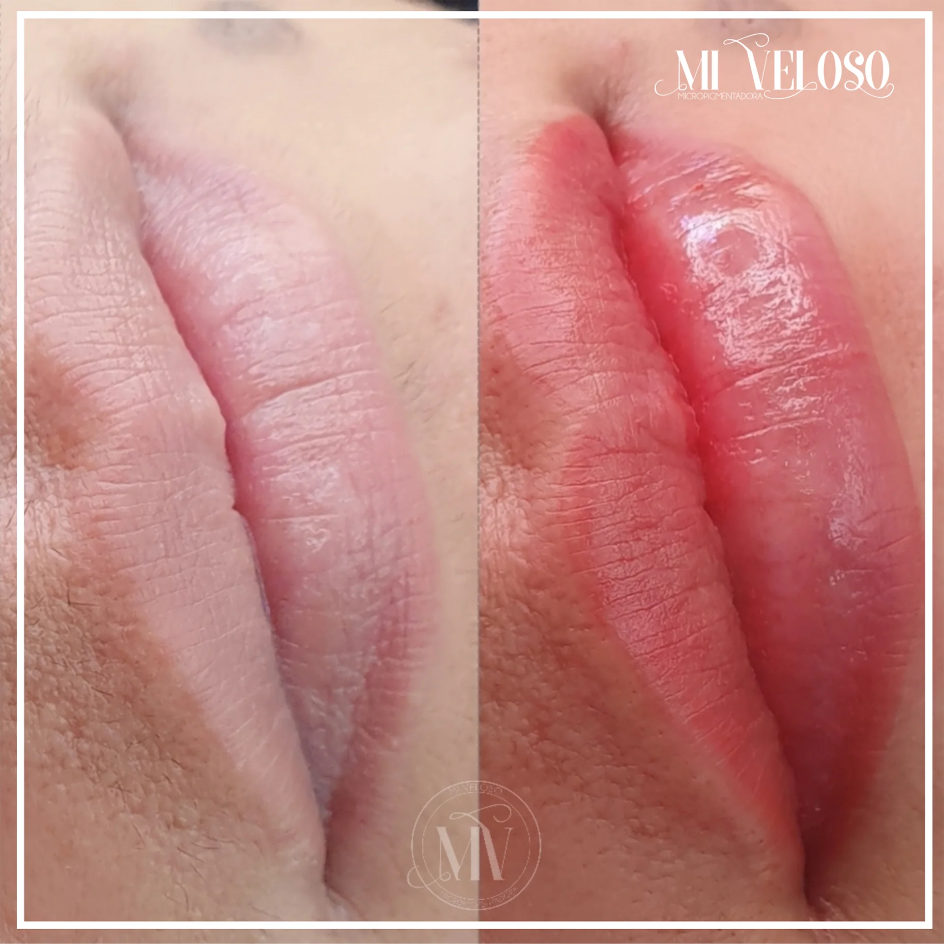 Micro-Labial-em-Sobradinho-DF-02