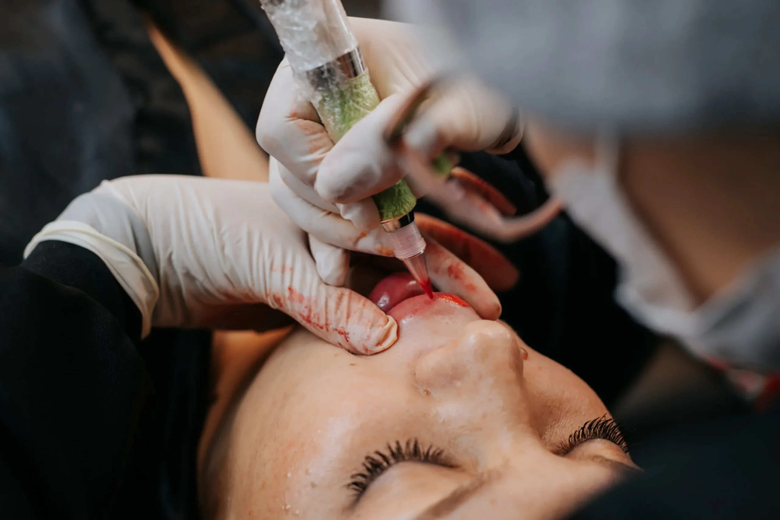 Micro-Labial-em-Sobradinho-DF-04