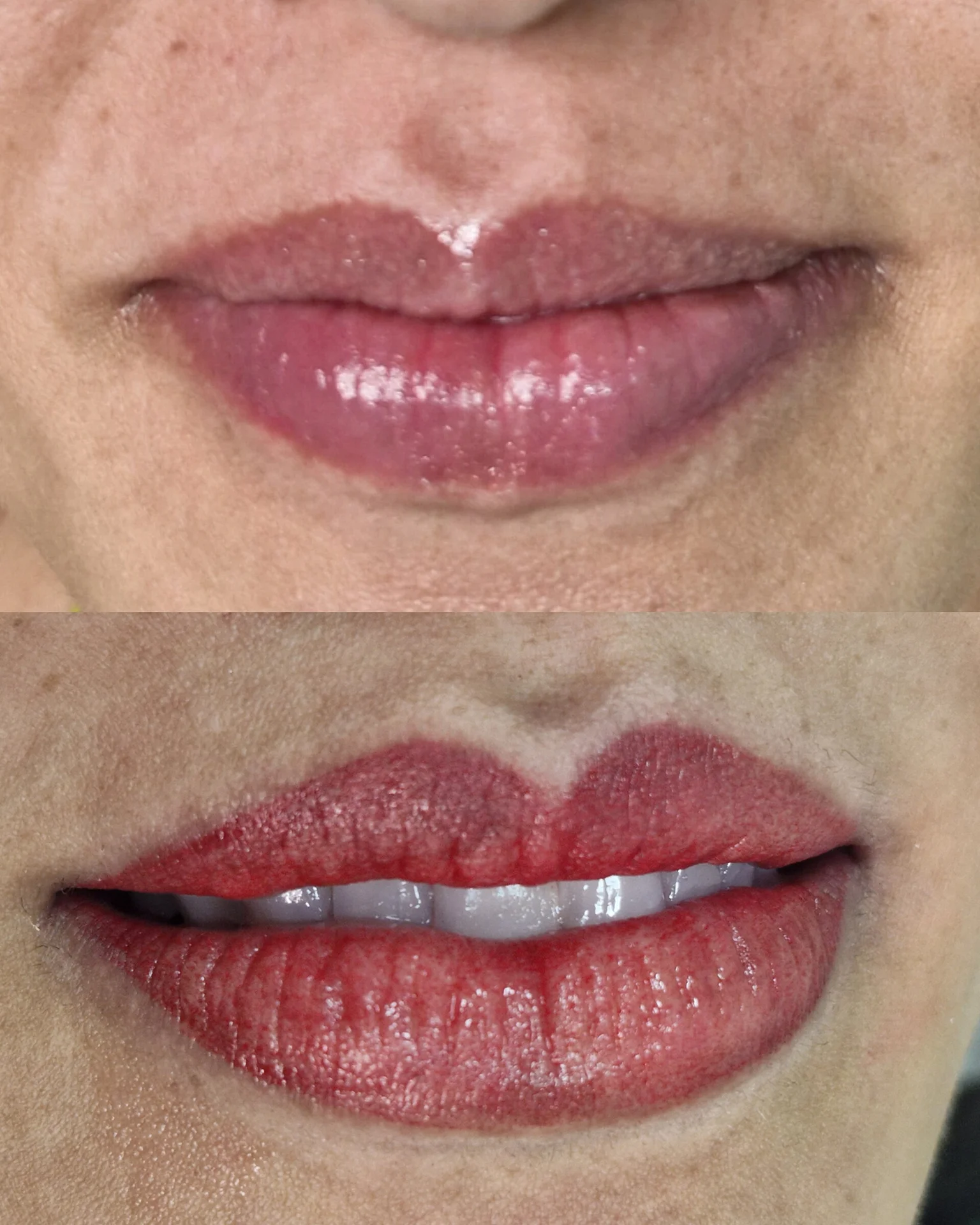 Micro-Labial-em-Sobradinho-DF-06