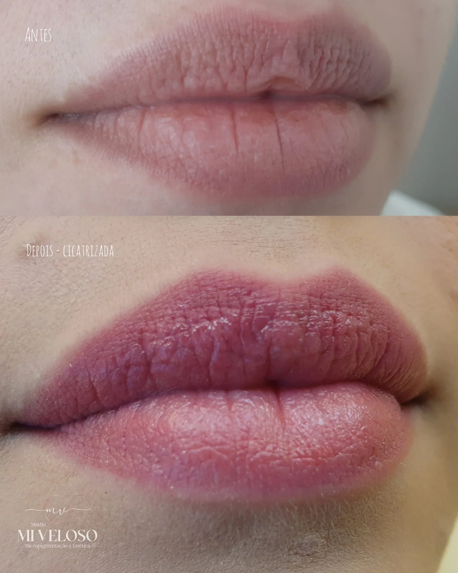 Micro-Labial-em-Sobradinho-DF-10