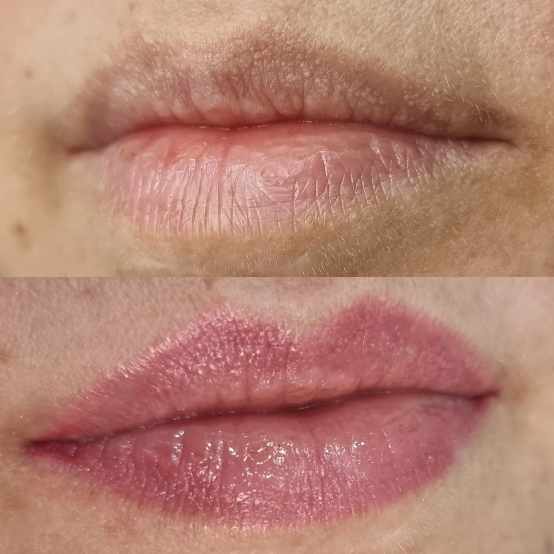Micro-Labial-em-Sobradinho-DF-11
