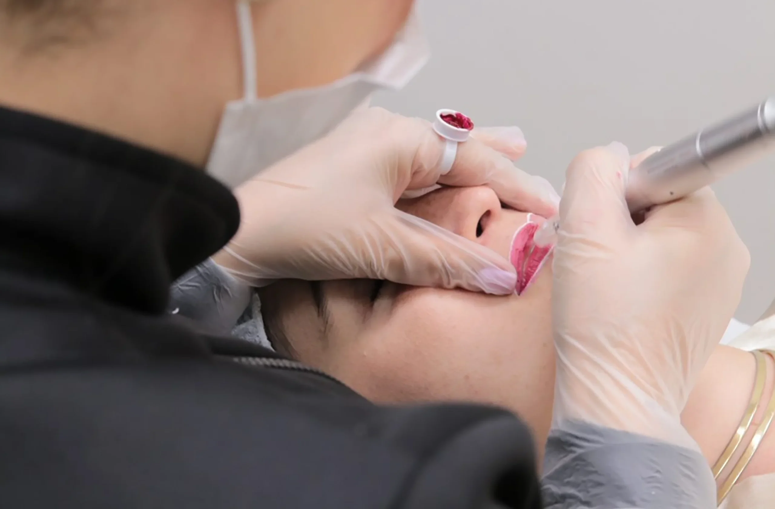 Micro-Labial-em-Sobradinho-DF-21