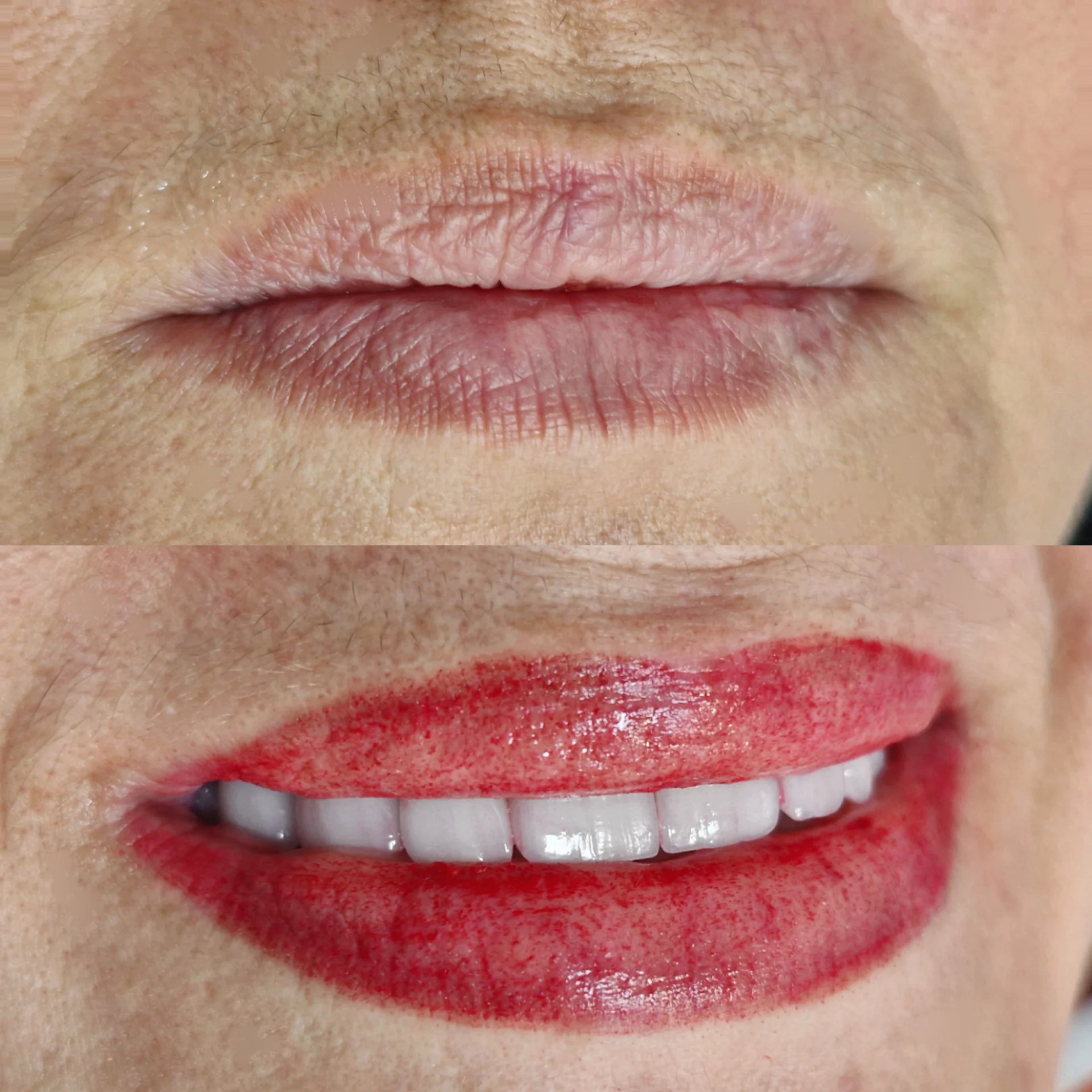 Micro-Labial-em-Sobradinho-DF-24