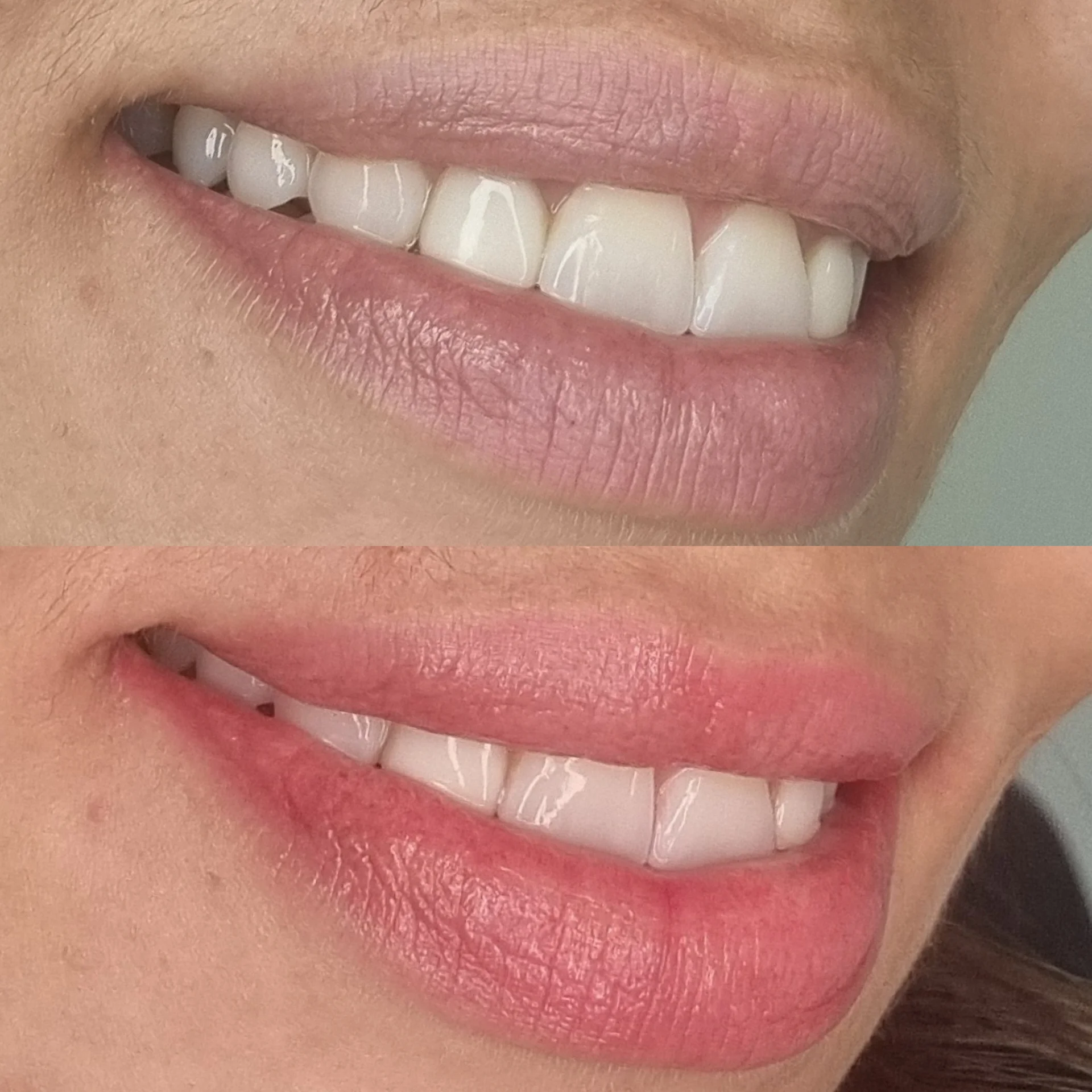 Micro-Labial-em-Sobradinho-DF-25