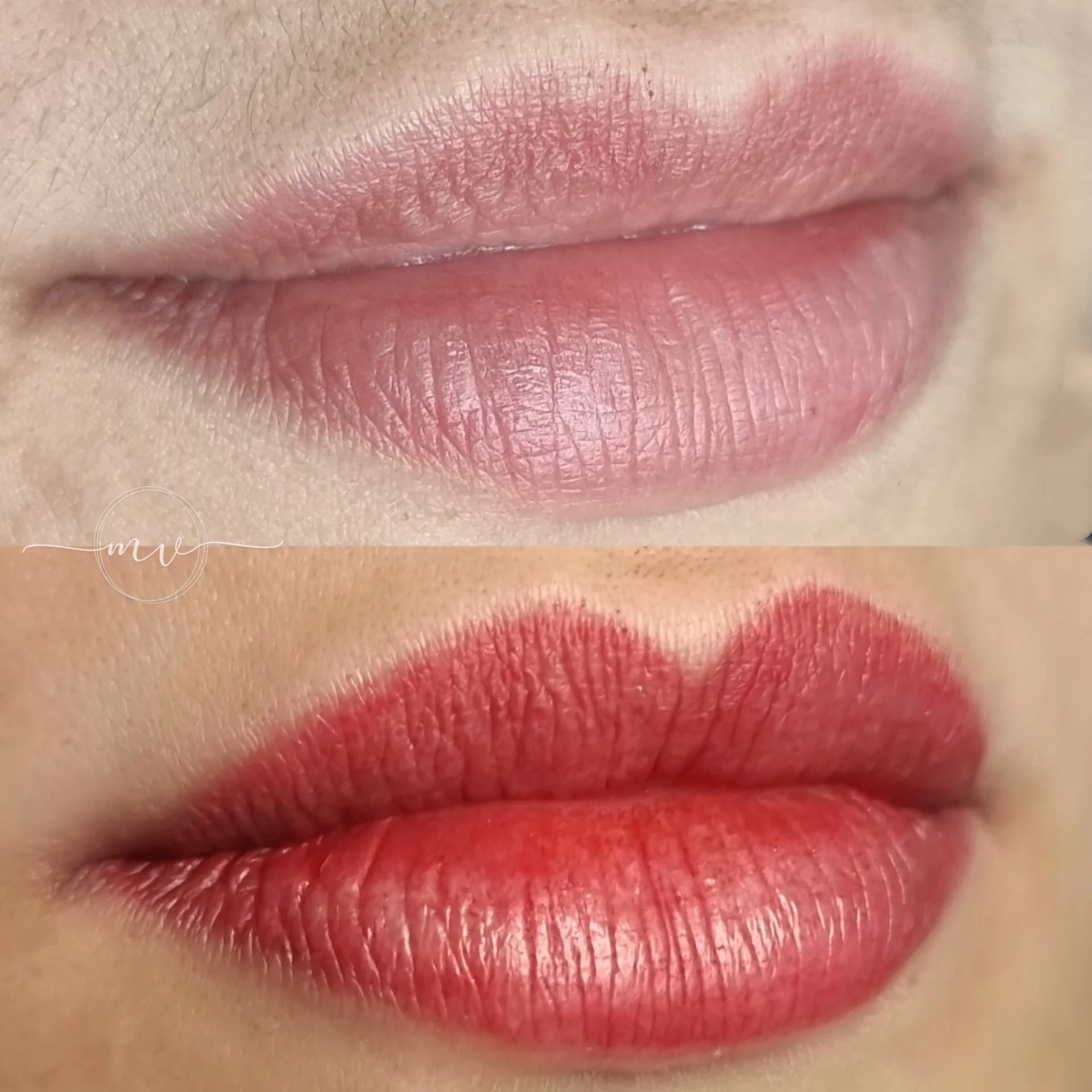 Micro-Labial-em-Sobradinho-DF-26