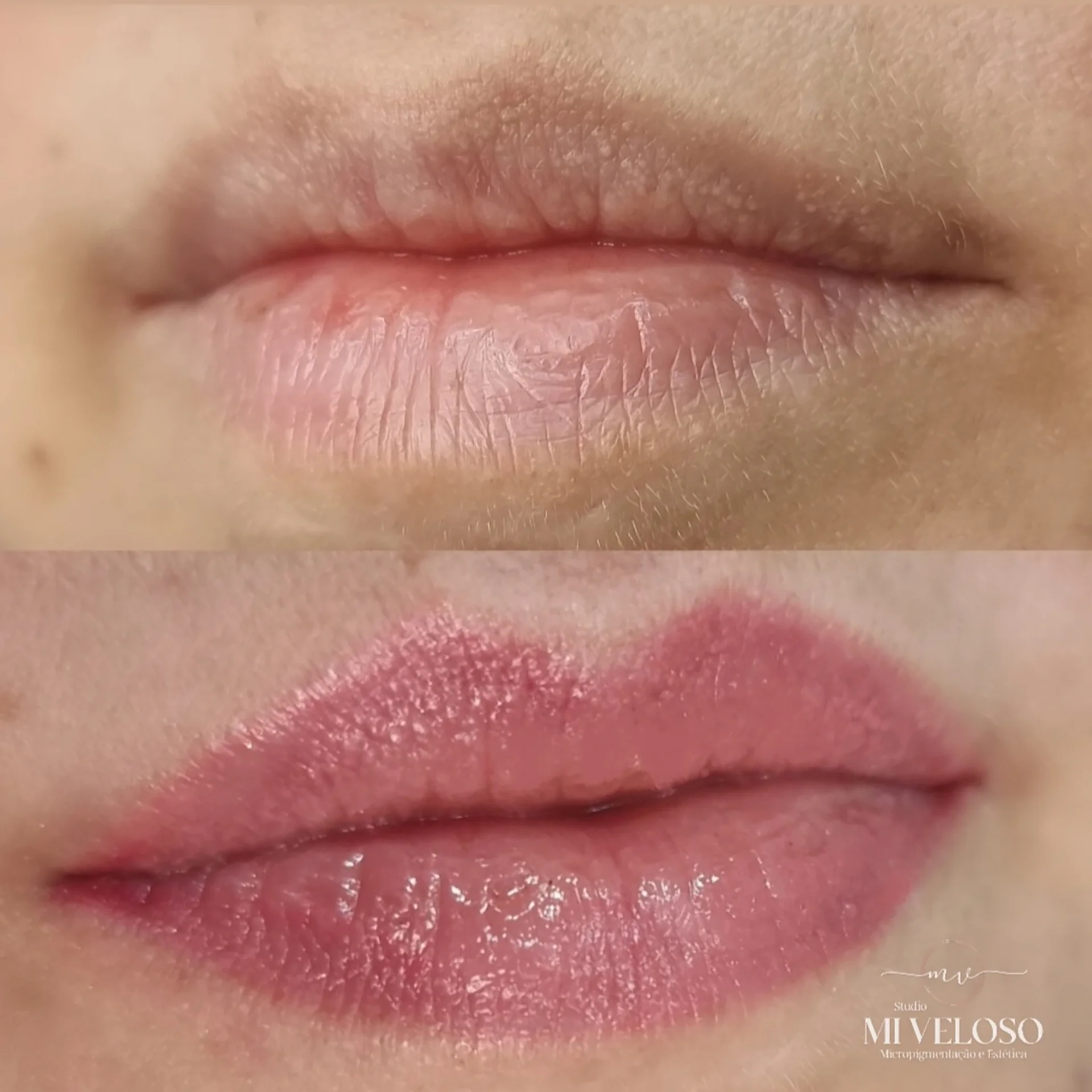 Micro-Labial-em-Sobradinho-DF-28