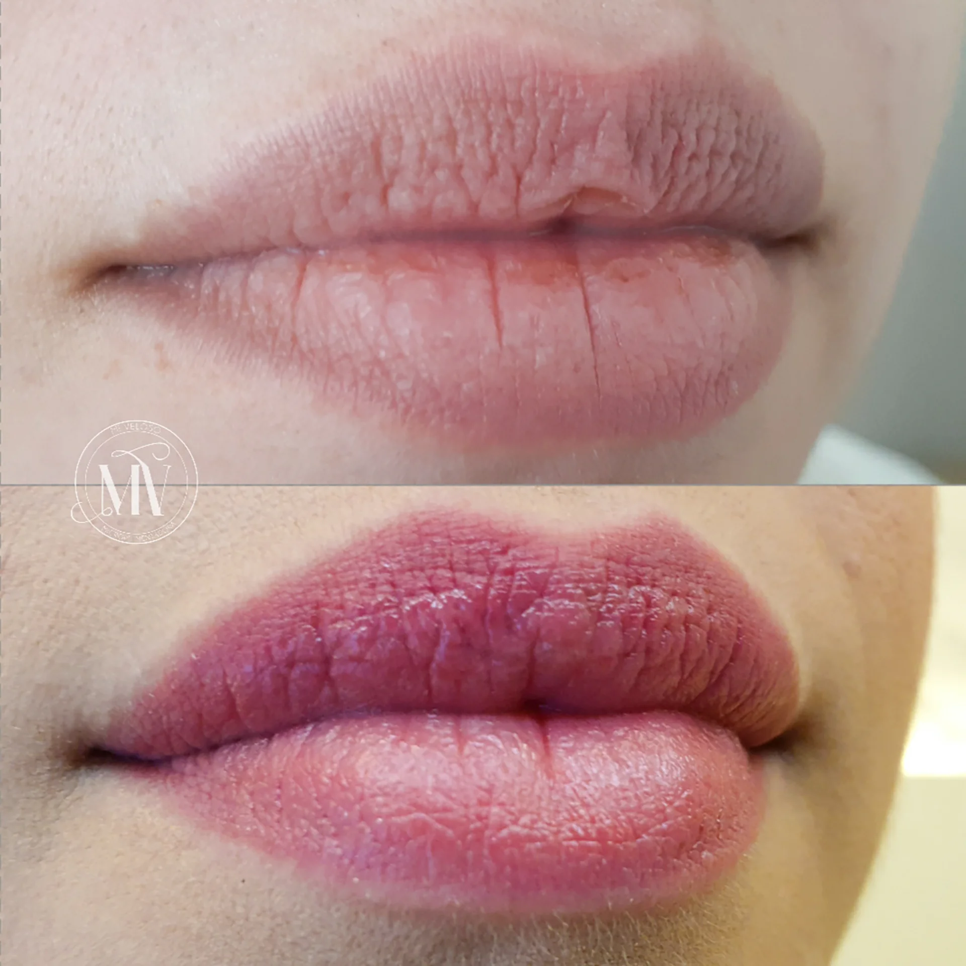 Micro-Labial-em-Sobradinho-DF-30
