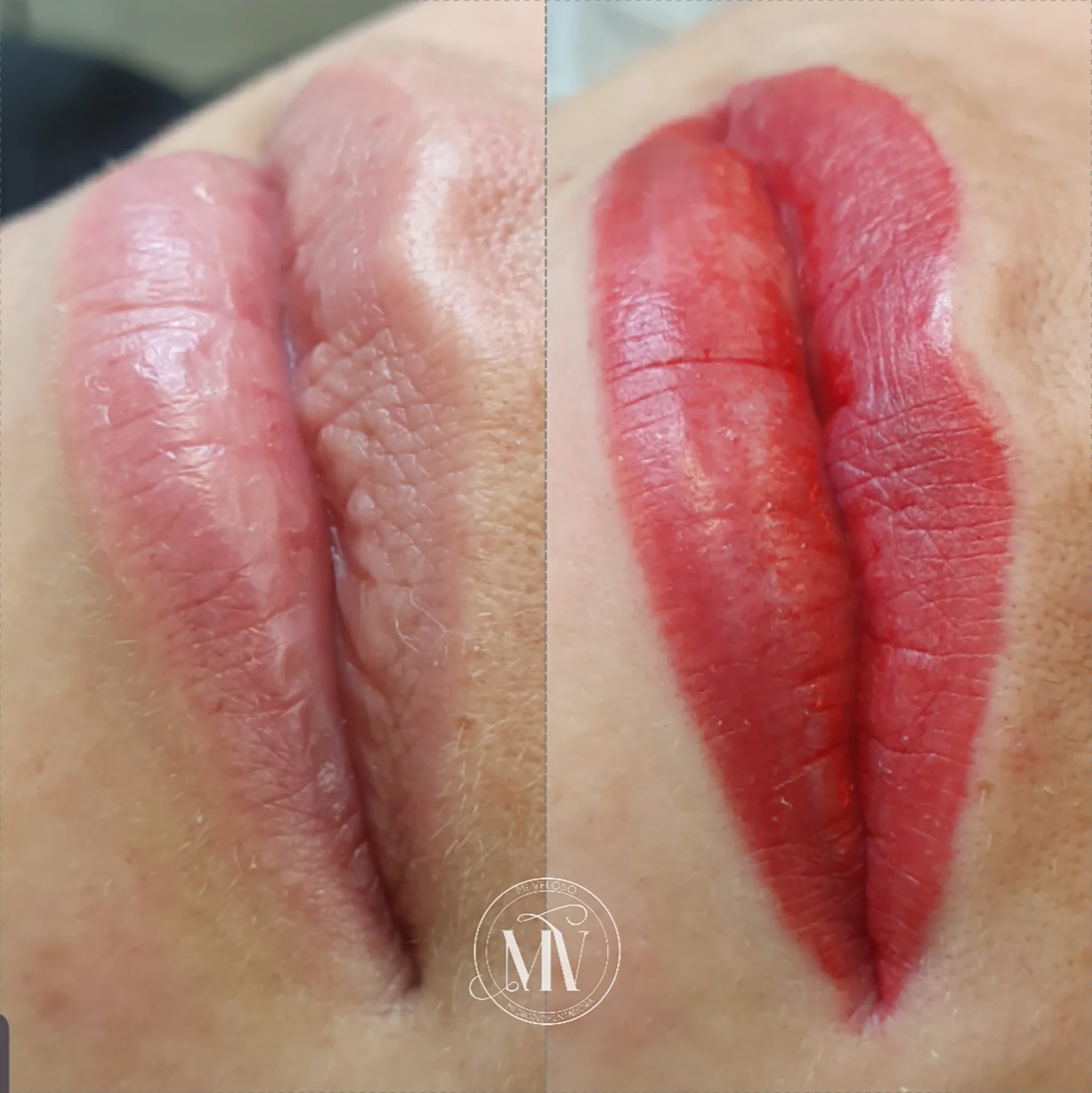 Micro-Labial-em-Sobradinho-DF-31