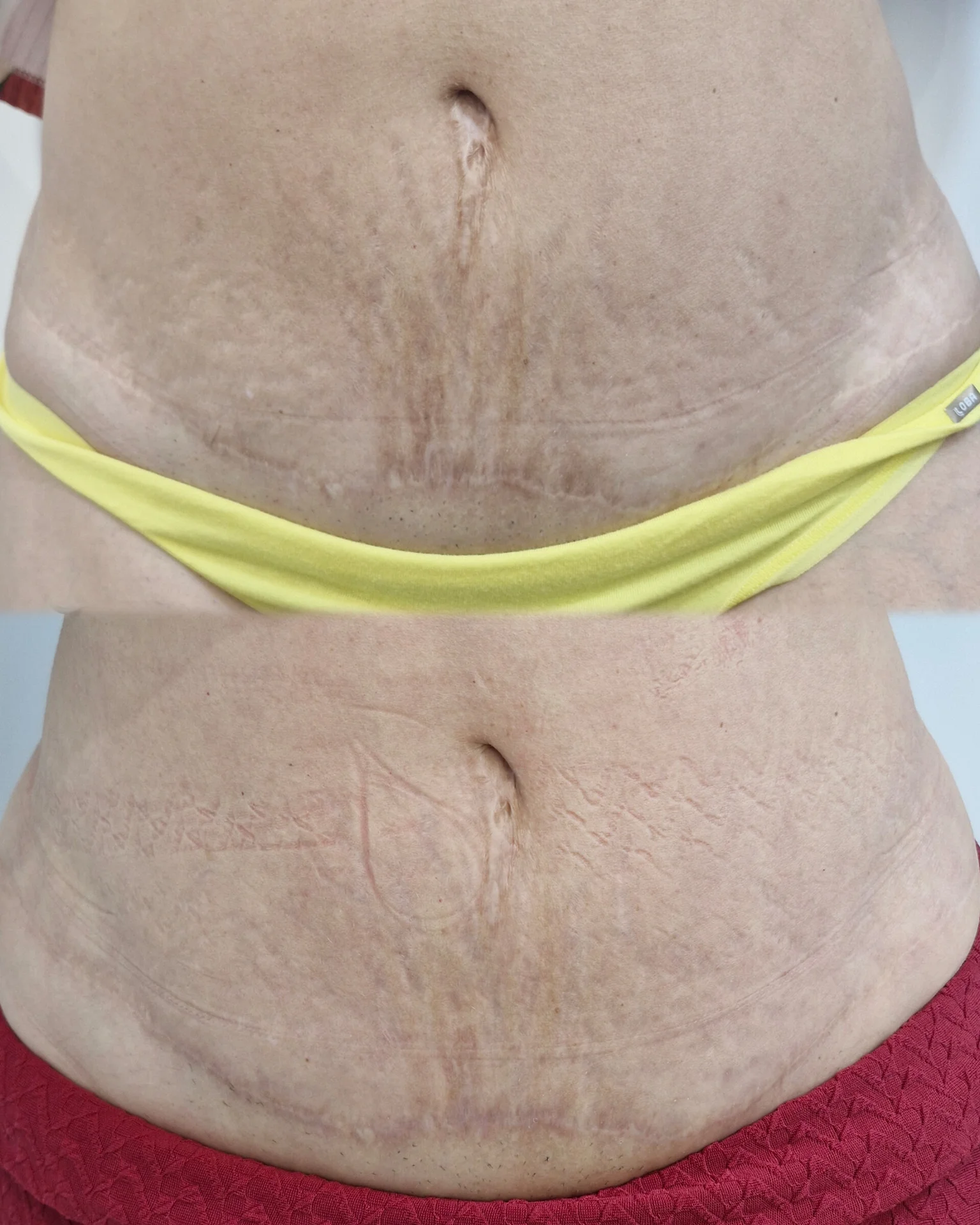 Tratamento-Cicatriz-DF-01