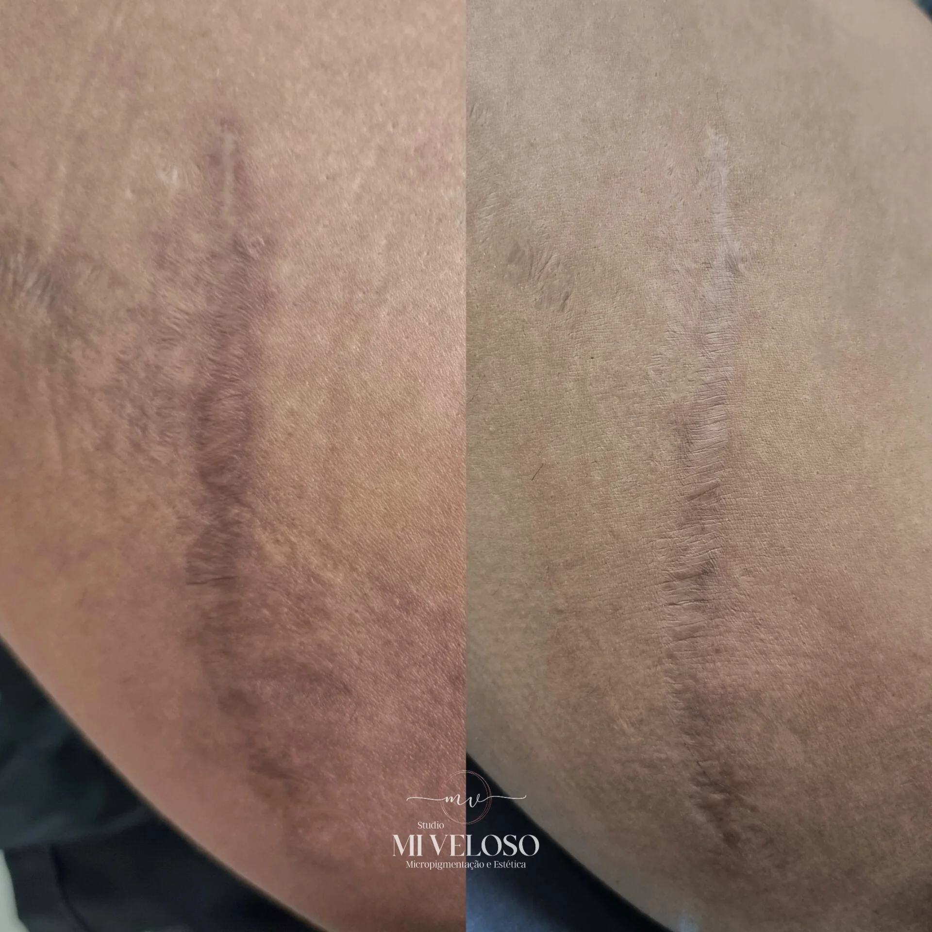 Tratamento-Cicatriz-DF-02