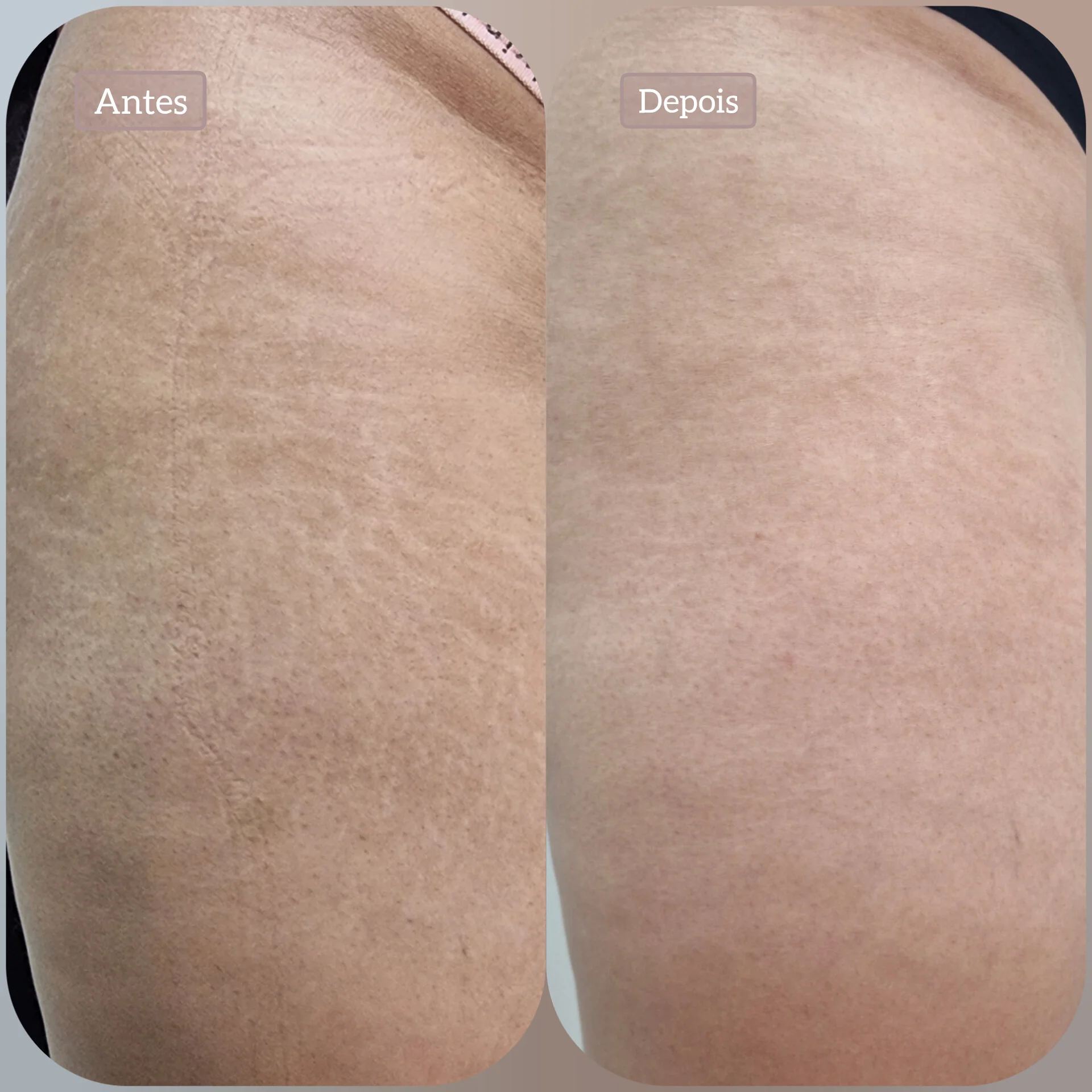 Tratamento-Estrias-DF-01