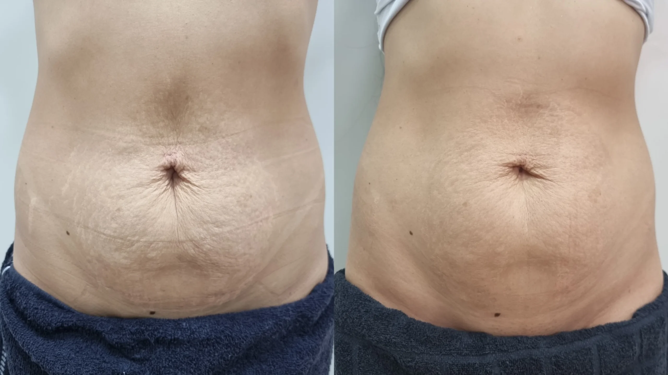 Tratamento-Estrias-DF-02