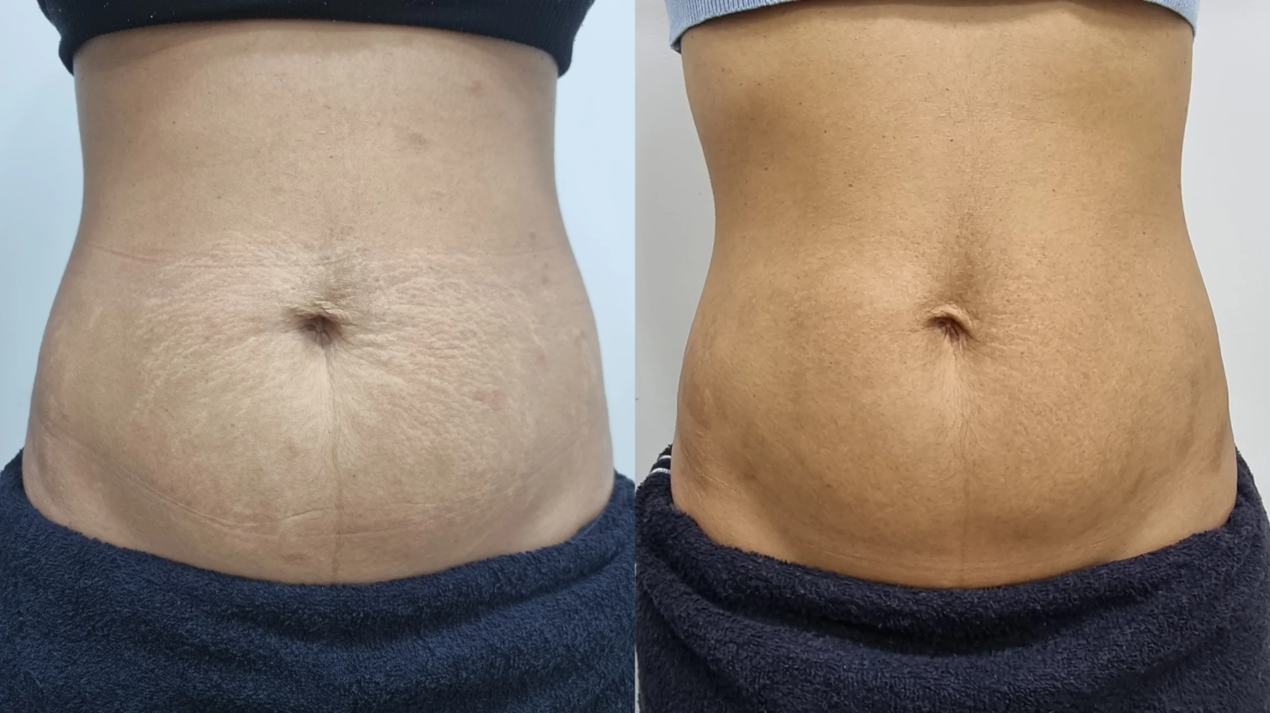 Tratamento-Estrias-DF-03