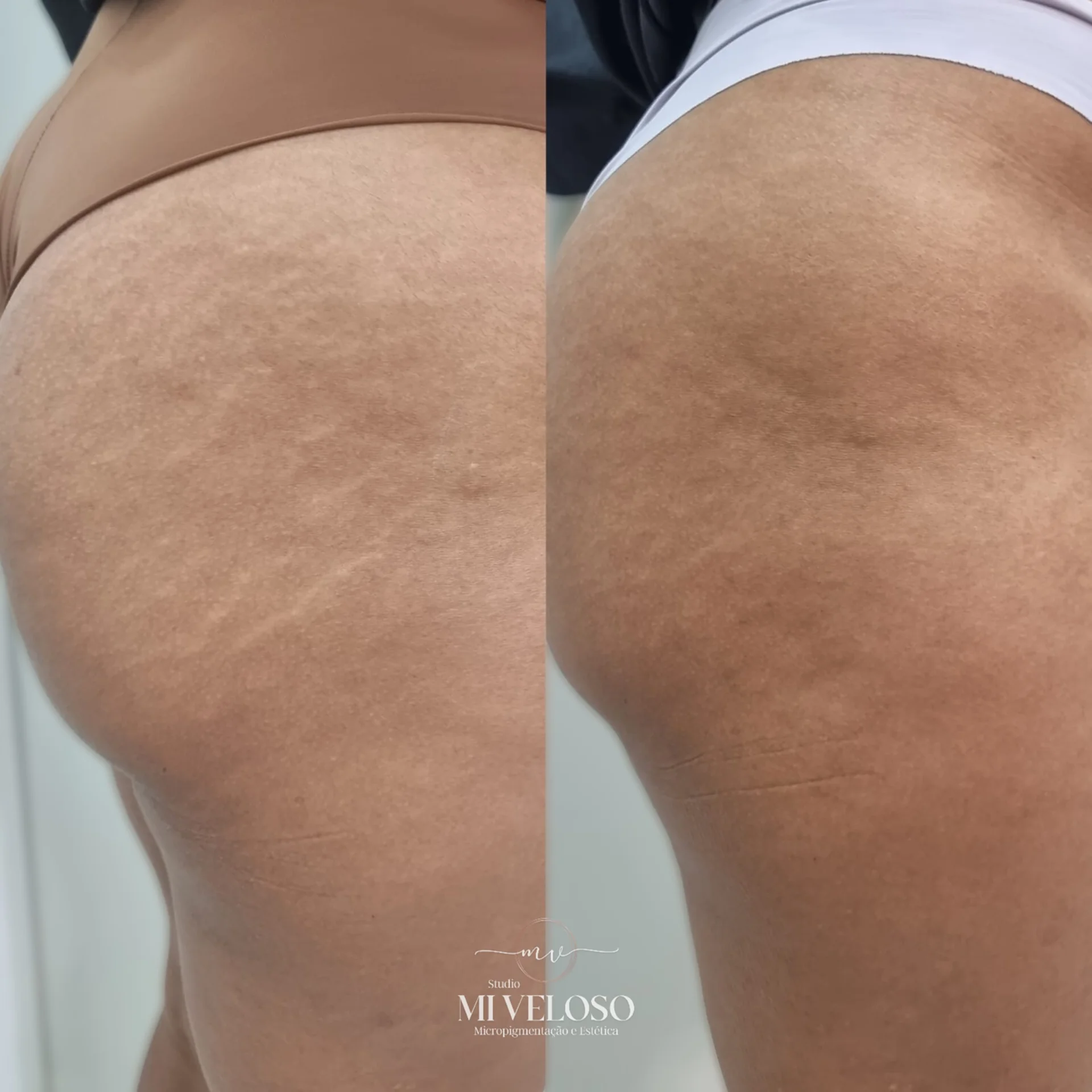 Tratamento-Estrias-DF-04